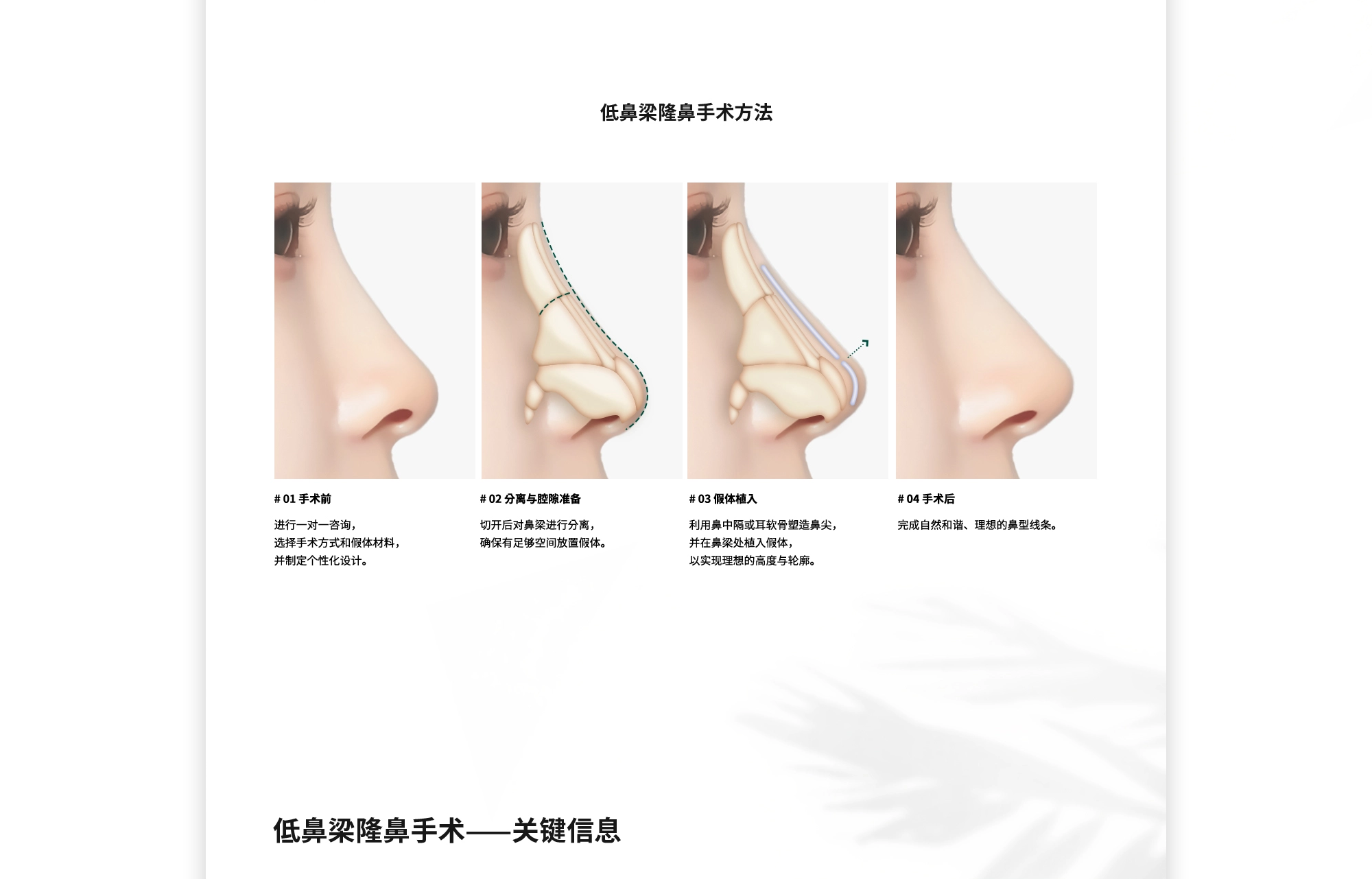 [低鼻梁隆鼻手术方法] # 01 手术前 : 进行一对一咨询，选择手术方式和假体材料，并制定个性化设计。  # 02 分离与腔隙准备 : 切开后对鼻梁进行分离，确保有足够空间放置假体。  # 03 假体植入 : 利用鼻中隔或耳软骨塑造鼻尖，并在鼻梁处植入假体，以实现理想的高度与轮廓。  # 04 手术后 : 完成自然和谐、理想的鼻型线条。