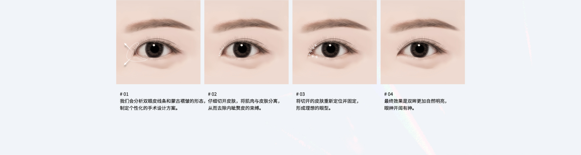 # 01 : 我们会分析双眼皮线条和蒙古褶皱的形态，制定个性化的手术设计方案。  # 02 : 仔细切开皮肤，将肌肉与皮肤分离，从而去除内眦赘皮的束缚。  # 03 : 将切开的皮肤重新定位并固定，形成理想的眼型。  # 04 : 最终效果是双眸更加自然明亮，眼神开阔有神。