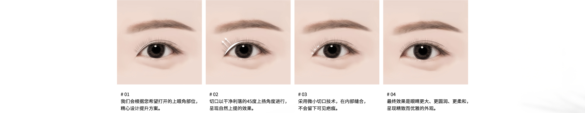 # 01 : 我们会根据您希望打开的上眼角部位，精心设计提升方案。  # 02 : 切口以干净利落的45度上扬角度进行，呈现自然上提的效果。  # 03 : 采用微小切口技术，在内部缝合，不会留下可见疤痕。  # 04 : 最终效果是眼睛更大、更圆润、更柔和，呈现精致而优雅的外观。