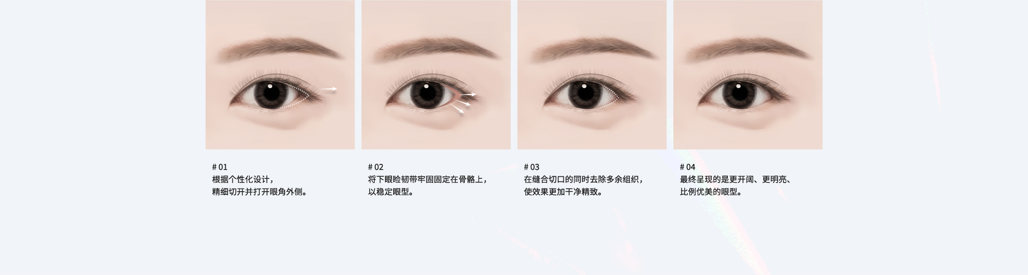 # 01 : 根据个性化设计，精细切开并打开眼角外侧。  # 02 : 将下眼睑韧带牢固固定在骨骼上，以稳定眼型。  # 03 : 在缝合切口的同时去除多余组织，使效果更加干净精致。  # 04 : 最终呈现的是更开阔、更明亮、比例优美的眼型。