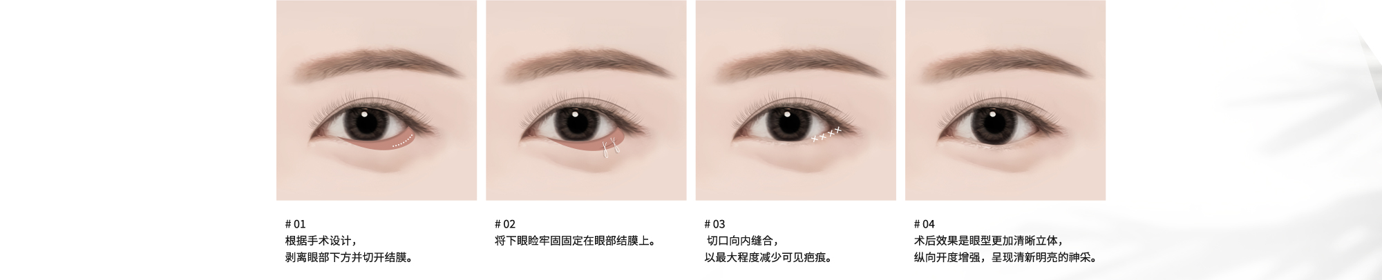 # 01 : 根据手术设计，剥离眼部下方并切开结膜。  # 02 : 将下眼睑牢固固定在眼部结膜上。  # 03 : 切口向内缝合，以最大程度减少可见疤痕。  # 04 : 术后效果是眼型更加清晰立体，纵向开度增强，呈现清新明亮的神采。