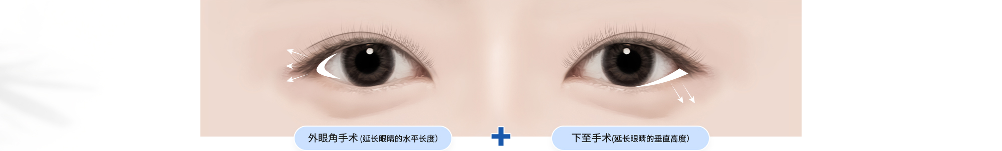 外眼角手术 (延长眼睛的水平长度）+ 下至手术(延长眼睛的垂直高度）