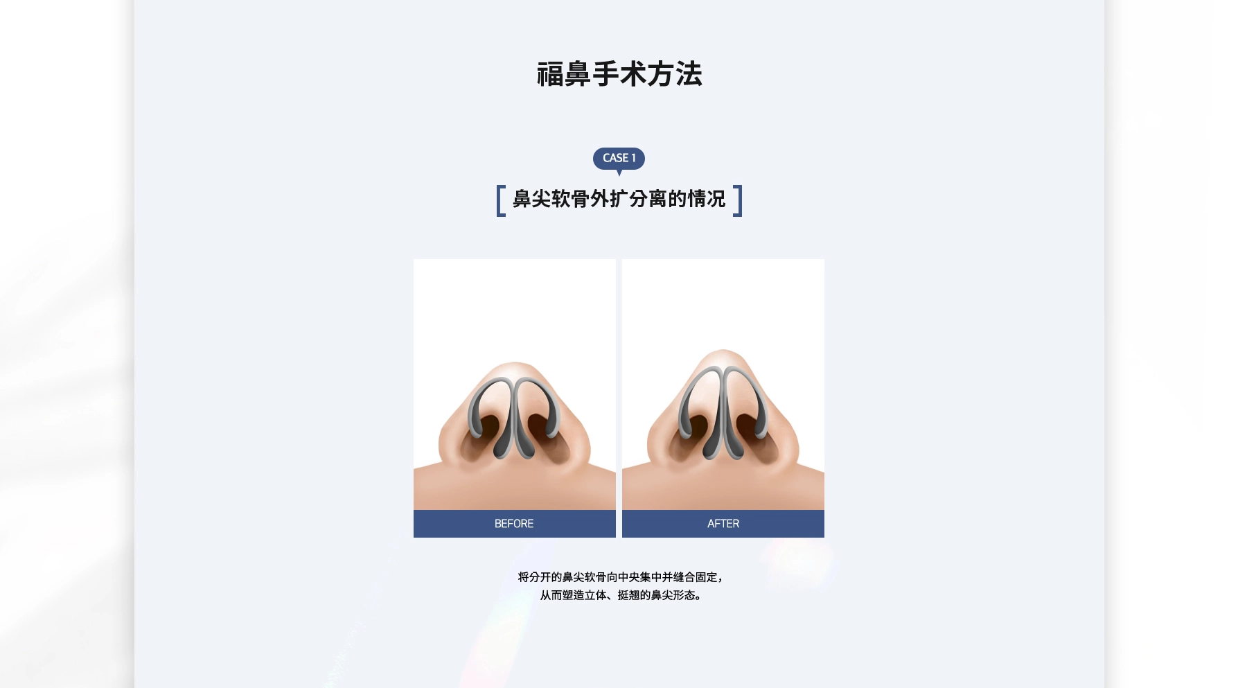 복코성형 수술방법 CASE 1