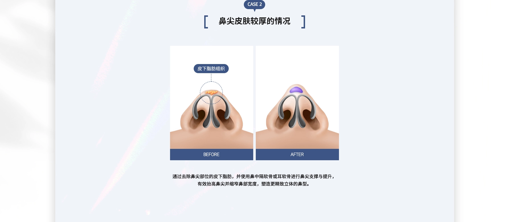 복코성형 수술방법 CASE 2