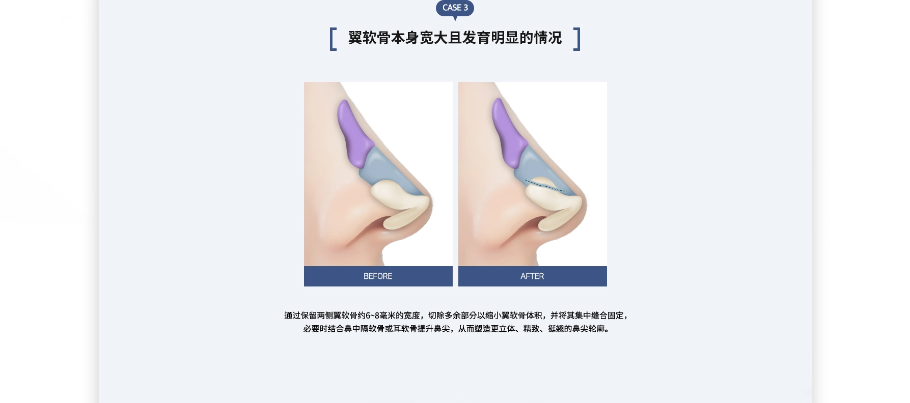 복코성형 수술방법 CASE 3
